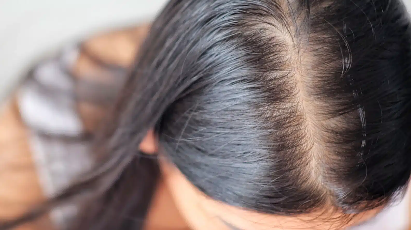 Hair-Loss-1