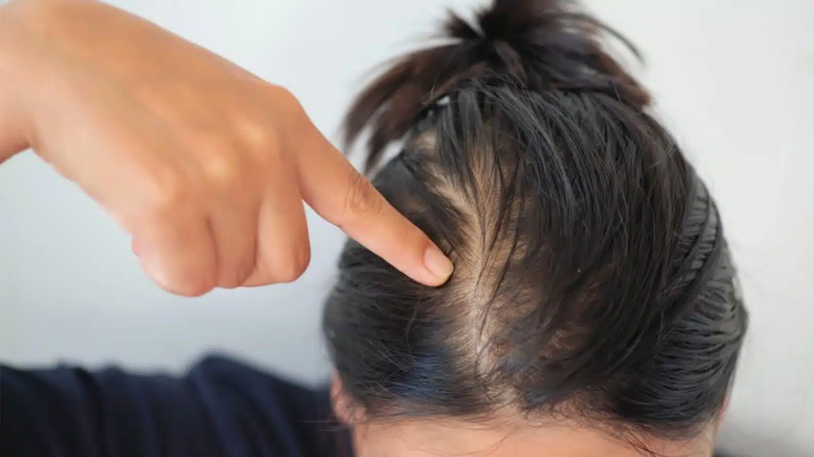 Hair-Loss-2
