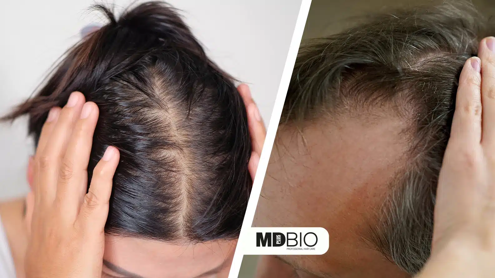 Understanding-DHT-and-Hair-Loss