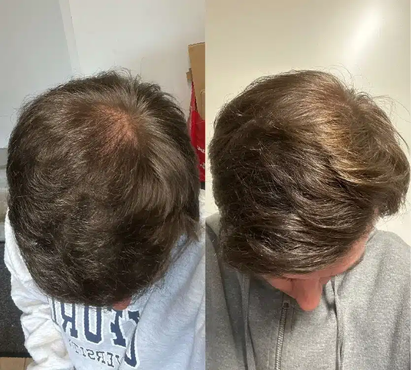 Hair transplant care