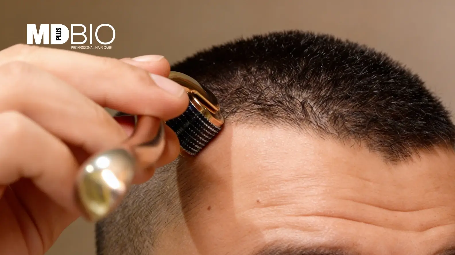 Microneedling for Hair Growth- Complete Guide to Dermaroller Treatment